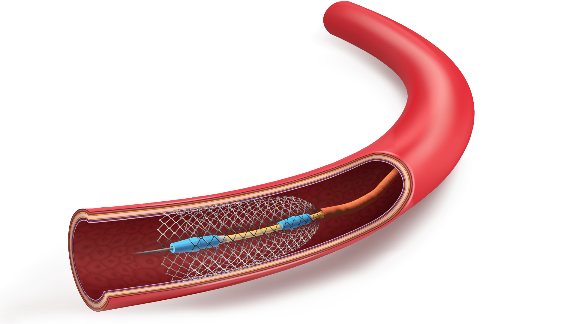 Stent