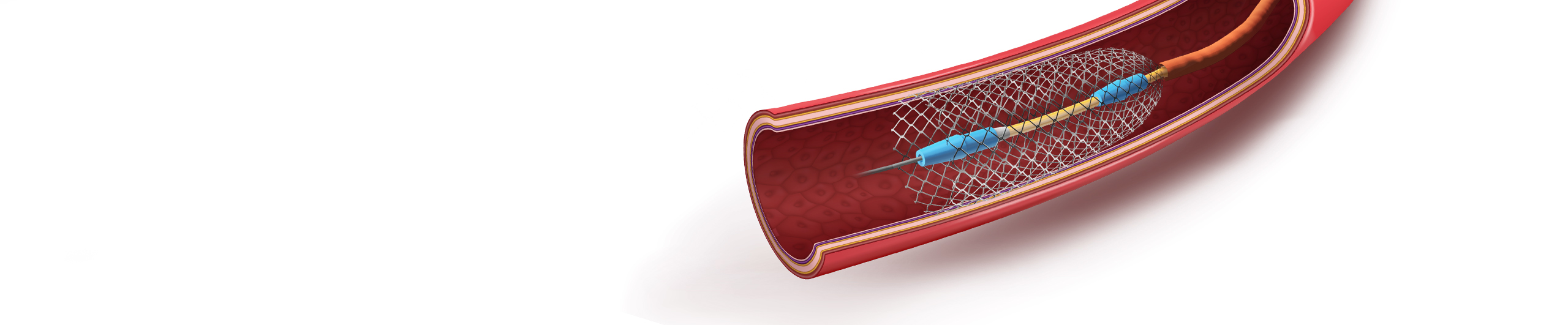 Stent