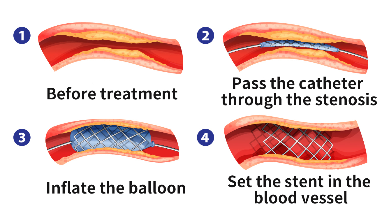Balloon-expandable Stent (Co-Cr)
