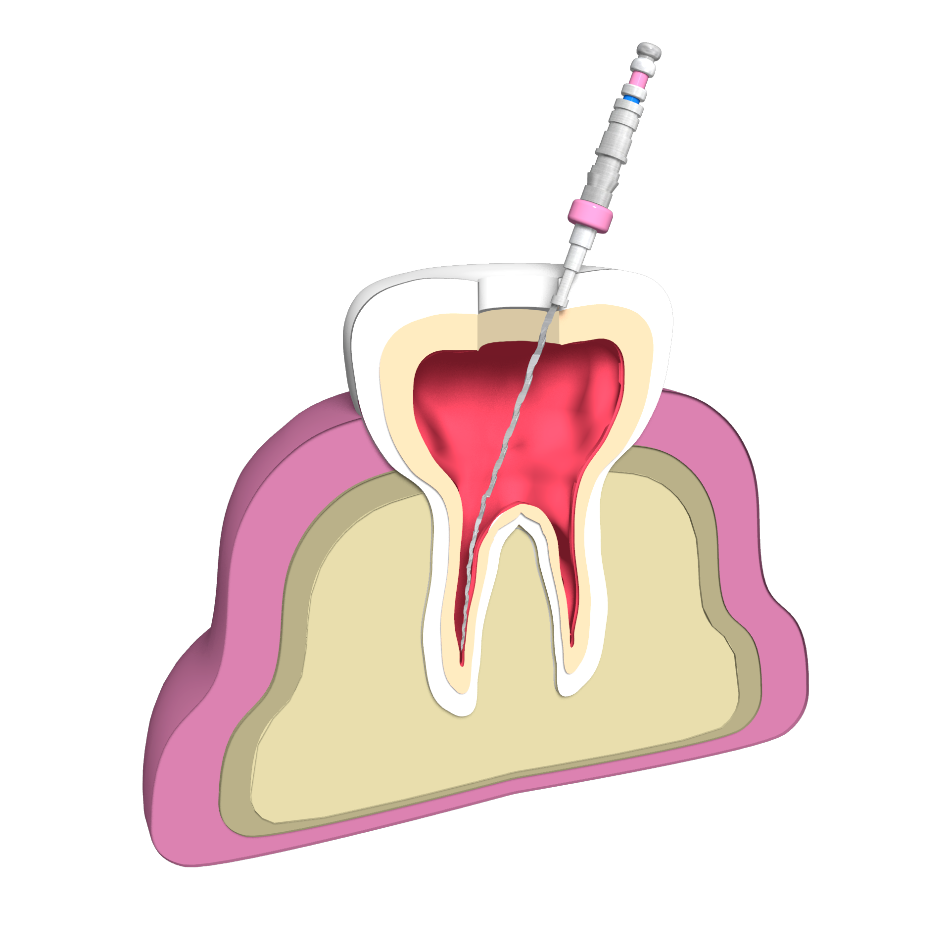 Dental file made of Ni-Ti wire