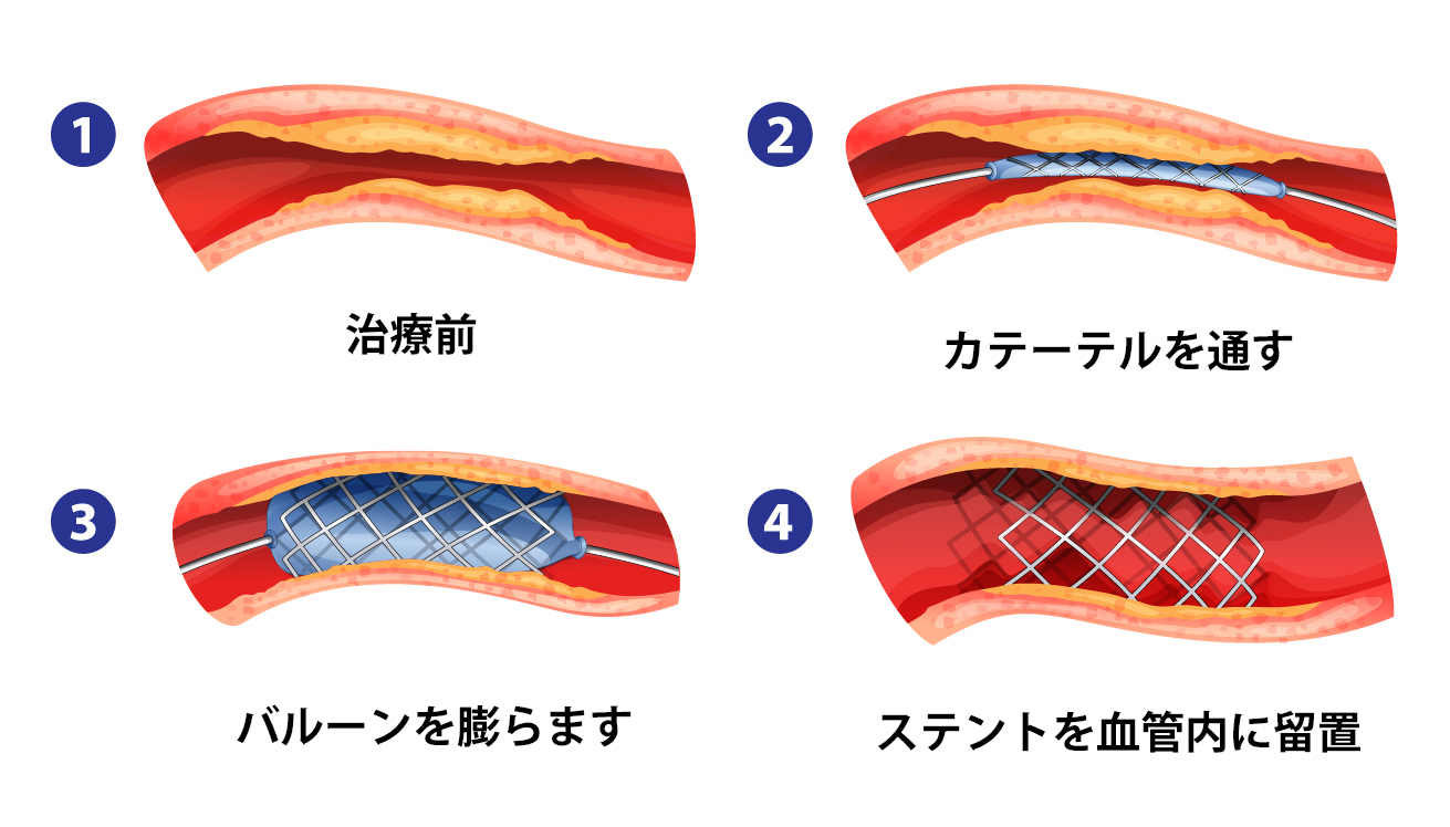 バルーン拡張型ステント（Co-Cr）