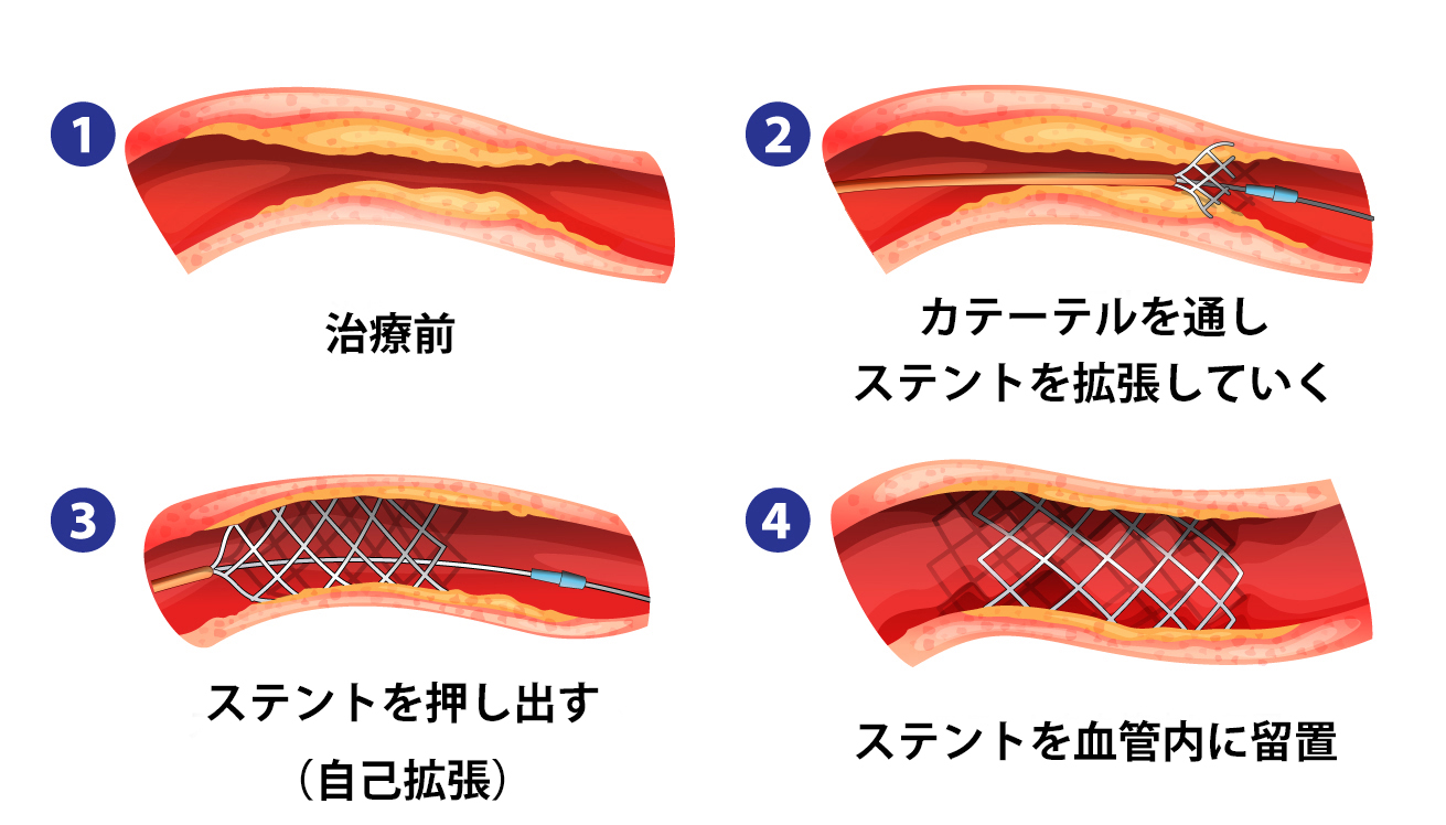 血管拡張の原因は何ですか?